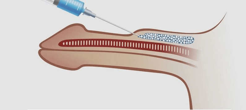 injekcia do penisu